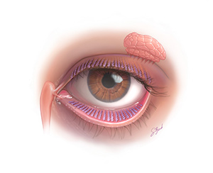 The image displays a close-up illustration of an eye with various medical details such as the eyeball, iris, pupil, eyelashes, and surrounding skin tones, along with a depiction of the internal structure of the eye including the sclera, choroid, and optic nerve.