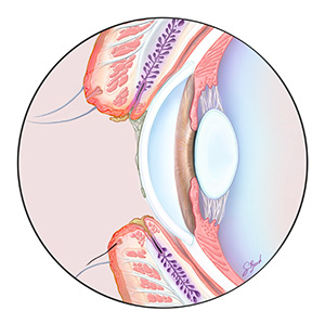 The image shows a detailed medical illustration of a human eye with surrounding structures, including the eyelid, eyebrows, and eyelashes, as well as the eyeball and its internal components such as the iris, pupil, and lens.