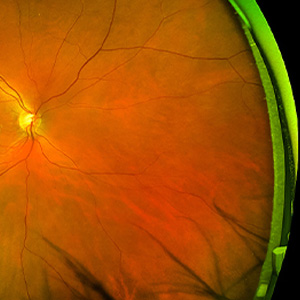 The image shows a close-up view of an eye with an iris and pupil, viewed through a microscope, with two different perspectives captured side by side.