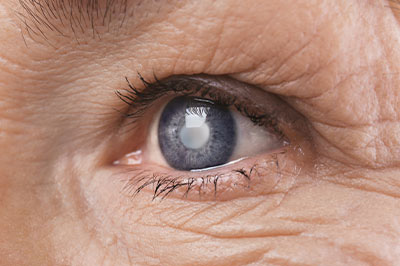 The image displays a close-up view of an elderly person s eye with blue iris and surrounding skin showing signs of aging, against a neutral background.